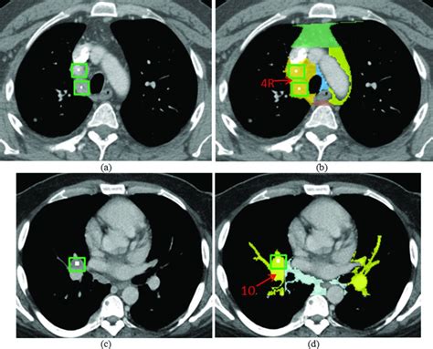 Mediastinal Lymph Node Detection And Station Mapping On Chest Ct Using