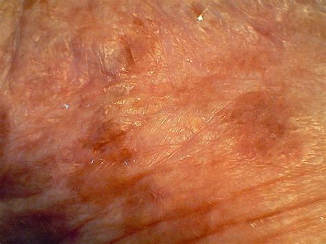 actinic keratosis treatment over the counter uk