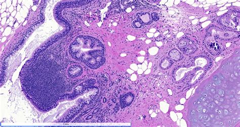 pathology outlines teratoma mature