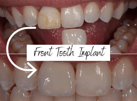 front tooth replacement   options