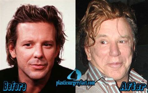 588 Best Images About Celebrity Plastic Surgery On