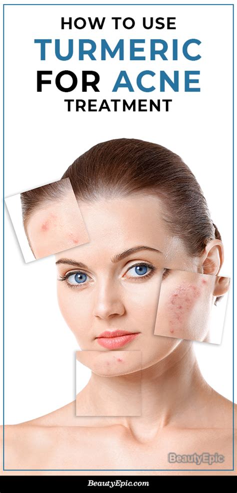 turmeric  acne