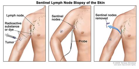 Lymph Node Surgery In Melanoma National Cancer Institute