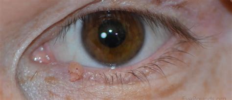 eyelid papilloma  diagnosis eyelid papilloma treatment