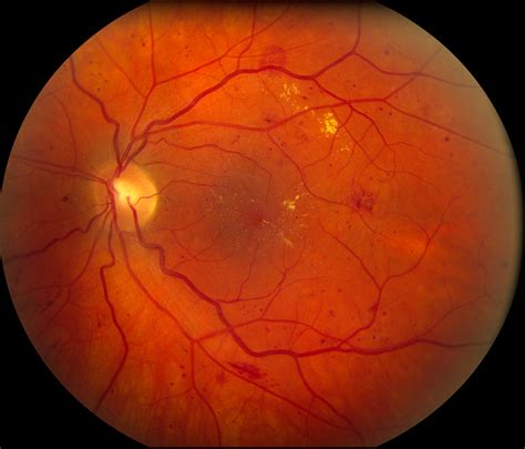 diabetic retinopathy carver college  medicine