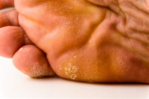 plantar wart laser foot surgery centers