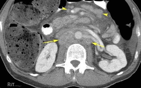 Rit Radiology Retroperitoneal Lymphadenopathy