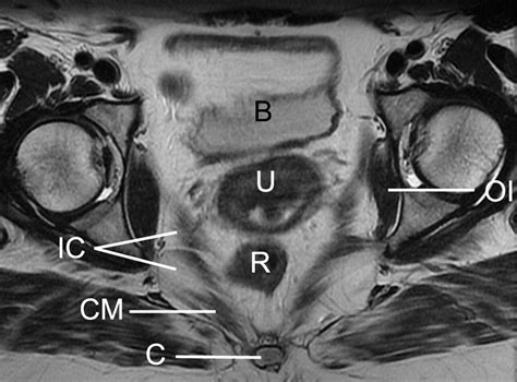 imaging of the female perineum in adults radiographics
