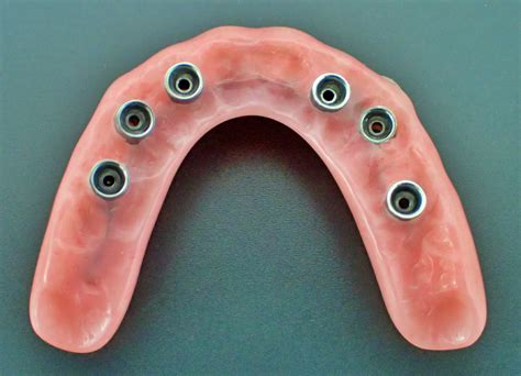 fixed implant retained hybrid dentures burnham denture clinic