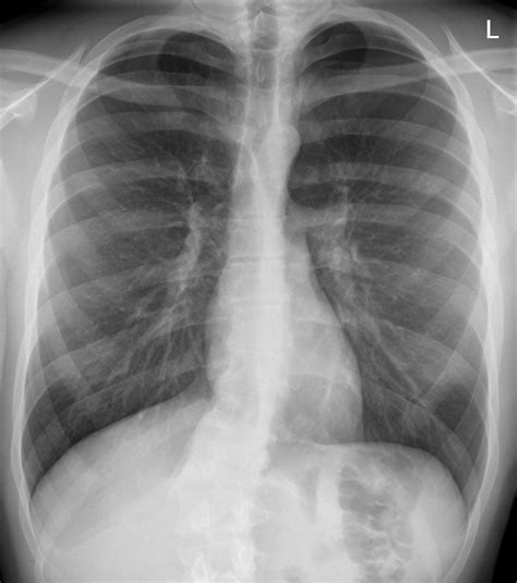 normal chest xray 9 buyxraysonline
