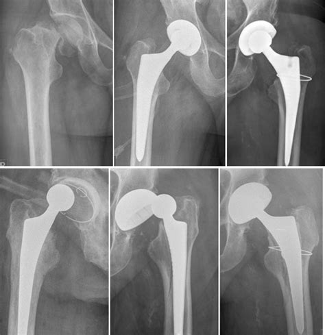 treatment of femoral neck fractures in elderly patients over 60 years