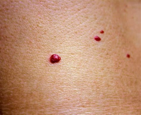 cherry angioma what do red moles mean and are they dangerous