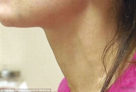 severe pulsating neck veins led doctors to diagnose her with