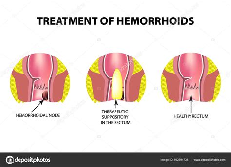 treatment of hemorrhoids with suppositories infographics vector
