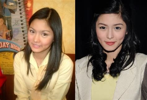 For The Win Did Kim Chiu Undergo Plastic Surgery