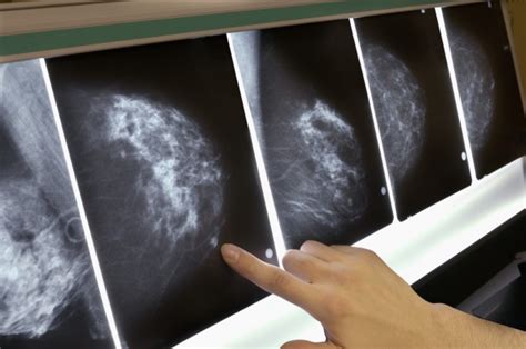 mammograms breast cancer screening as an individual patient decision