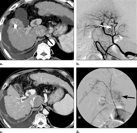 Hepatocellular Carcinoma In The Caudate Lobe Of The Liver Angiographic