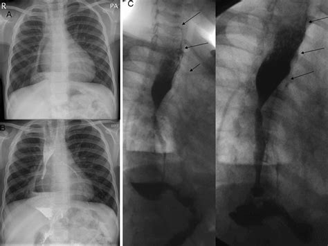 The Combination Of Pure Oesophageal Atresia With An Associated Missed H