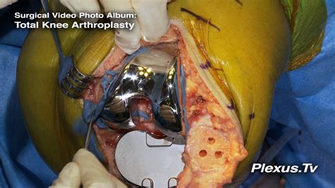 Total Knee Arthroplasty Surgical Video