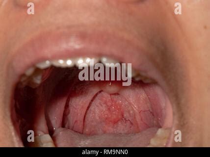 entzuendung der weichen gewebe im mund und schmerzen beim schlucken
