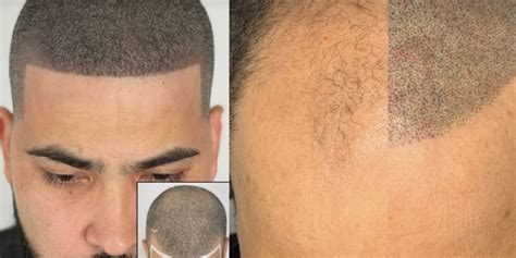 confidence boosting scalp micropigmentation session