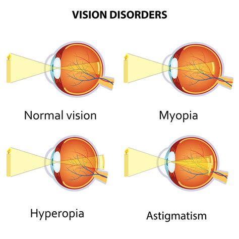 myopia hyperopia and astigmatism explained rebuild your