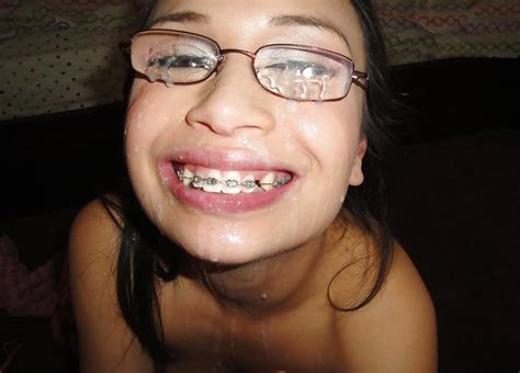 pic face braces 164 pics