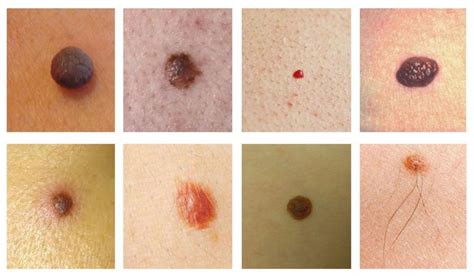 Teleconsultation For Mole Removal And Skin Cancer Melanoma The