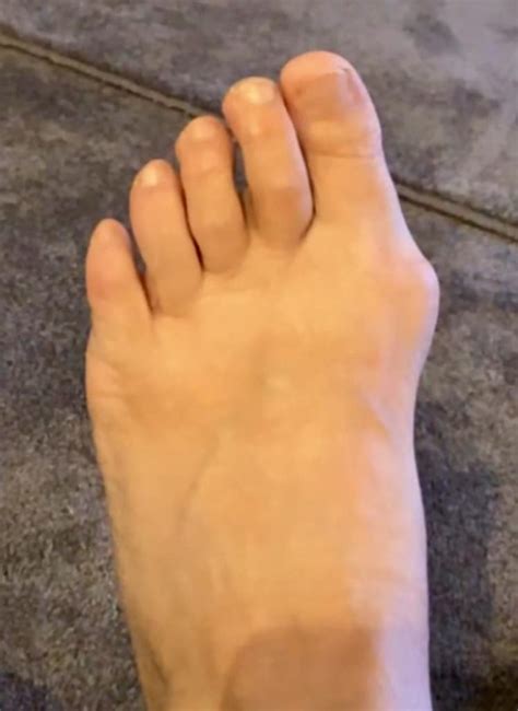 bump   side   foot pro feet podiatry