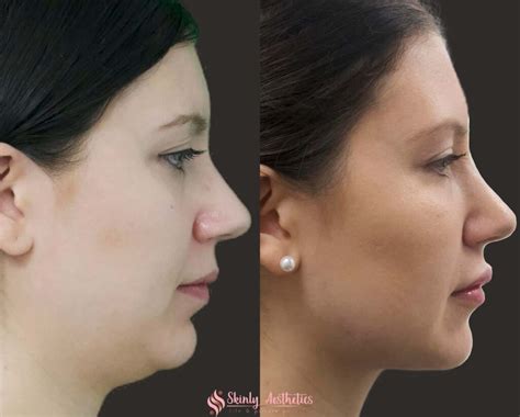 coolsculpting  double chin benefits costs results procedure steps