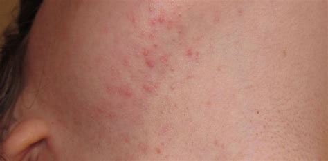 managing stress acne 8 month old