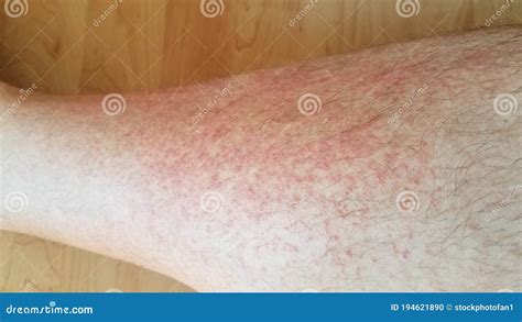 red rash  inflammation  male leg stock photo image  itchy
