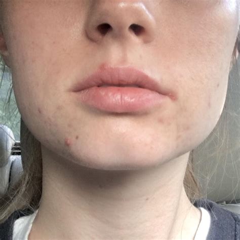 skin concern  time poster zits  lip  post  comments rskincareaddiction