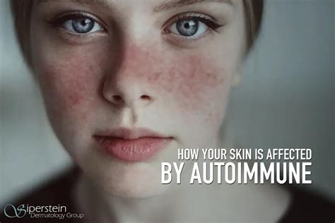 link  autoimmune diseases   skin