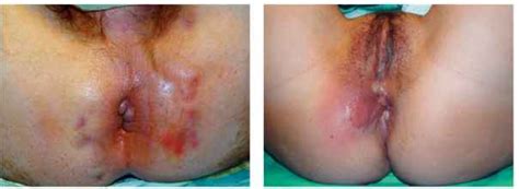 Perineal perianal abcess picture