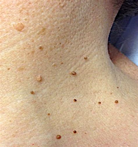the difference between skin tags and warts sterex