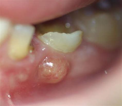 pop  dental abscess   hubpages