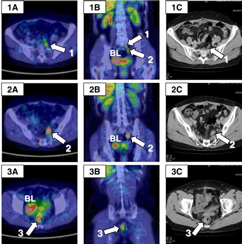 rectal lymph node metastasis in recurrent ovarian carcinoma essential