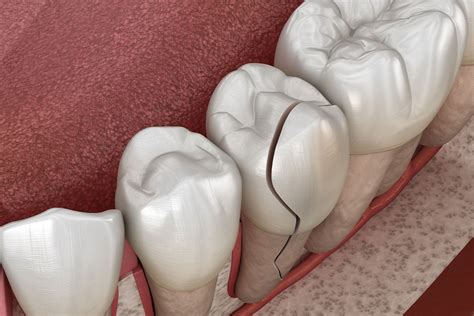 solutions pour remplacer une dent cassee clinique mfml