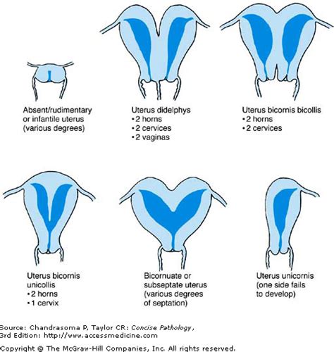 Chapter 53 The Uterus Vagina And Vulva Concise Pathology 3e Free Hot