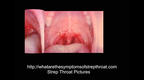 Strep Throat With No Tonsils Best Porno