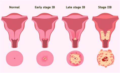 can cervical cancer cause early menopause world health organization