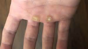Calluses from sex