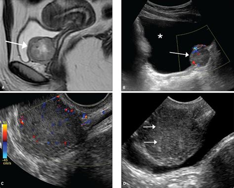 transvaginal ultrasoundguided biopsy  deep pelvic masses plett  journal
