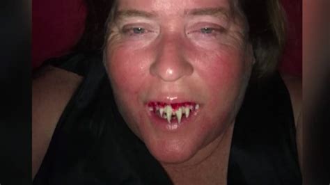Zombie Teeth Woman Gets Stuck With False Fangs Abc13 Houston