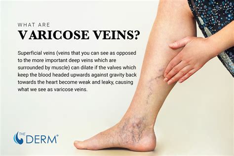 varicose veins whats  deal    heal  derm