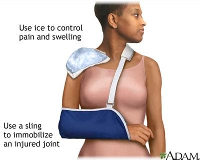 shoulder sling medlineplus medical encyclopedia image