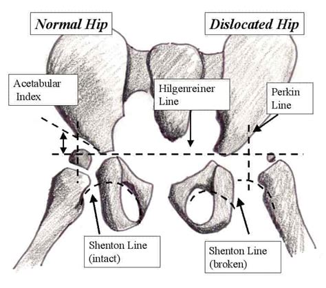 congenital dislocation of the hip cdh