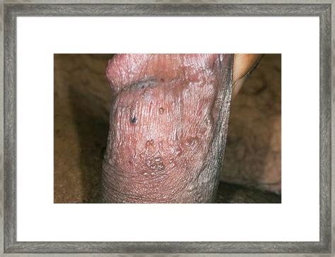 warts on the penis photograph by dr p marazzi science photo library