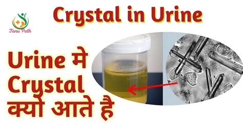 triple phosphate crystal alkaline urine youtube